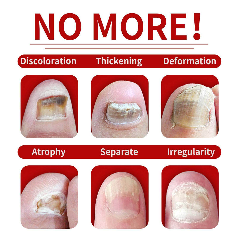 Jiasuying Ginger Nail Care Liquid, Repairs And Moisturizes Hand And Foot Nails, Makes Nails Shiny And Soft, And Improves Onychomycosis - EX-STOCK Canada