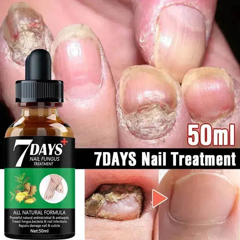 7DAYS Nail Fungus Treatment Serum Care Hand And Foot Care Removal - EX-STOCK Canada