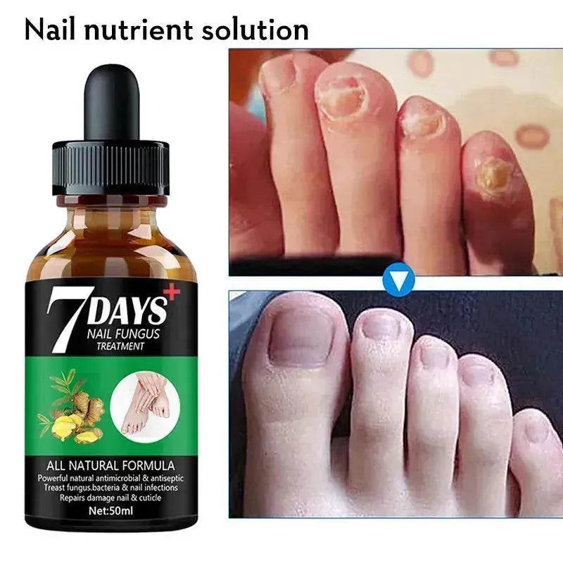 7DAYS Nail Fungus Treatment Serum Care Hand And Foot Care Removal - EX-STOCK Canada