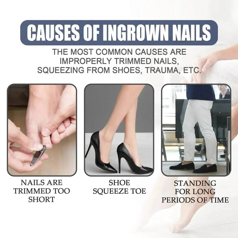 Relieving And Repairing Ingrown Nail Toe Nail Removing Meat Treatment Oil - EX-STOCK Canada