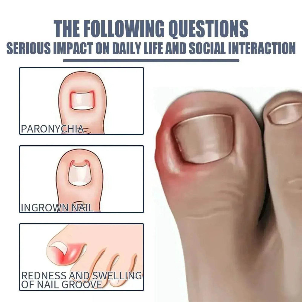 Relieving And Repairing Ingrown Nail Toe Nail Removing Meat Treatment Oil - EX-STOCK Canada