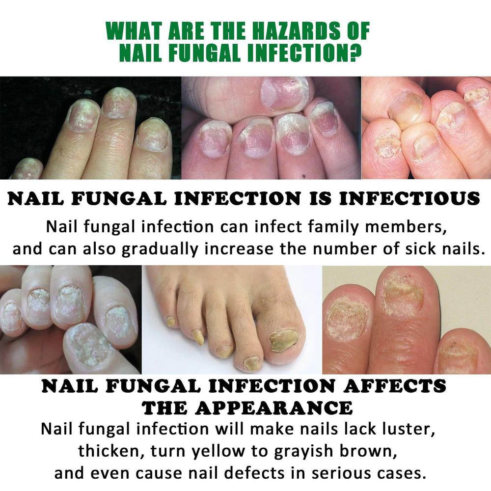 Jiasuying Ginger Nail Care Liquid, Repairs And Moisturizes Hand And Foot Nails, Makes Nails Shiny And Soft, And Improves Onychomycosis - EX-STOCK Canada