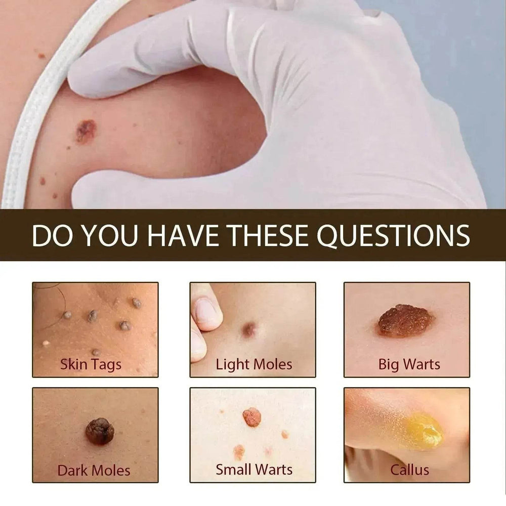 Wart Removal - Skin Cleansing Black Mole Wart Ointment Hand & Foot And Face - EX-STOCK Canada