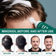 Minoxidil Anti-Hair Loss Mousse – Single Piece & Set Box