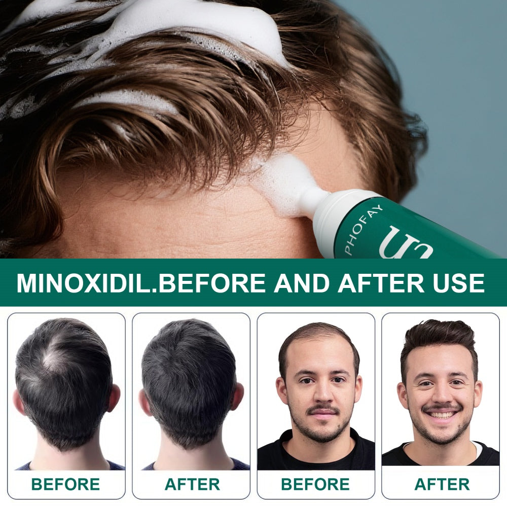 Minoxidil Anti-Hair Loss Mousse – Single Piece & Set Box