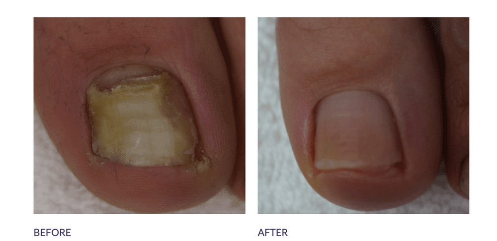 Spray Tincture Anti-Fongique pour Ongles FootlogixEX-STOCK Canada 