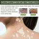 EELHOE White Spot Cleansing Serum PSORALCN White Spot Antibacterial Liquid. - EX-STOCK CANADA