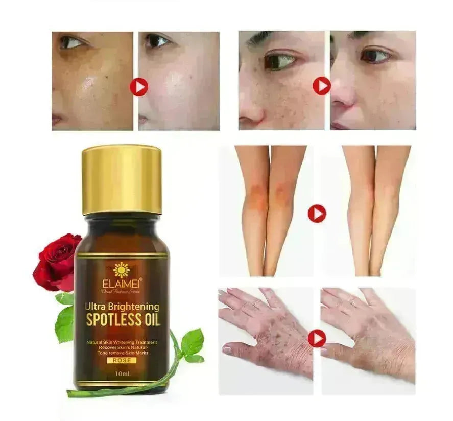 ELAIMEI Ultra Whitening Brightening Spotless Oil Freckles and Dark Spot Remover - EX-STOCK CANADA